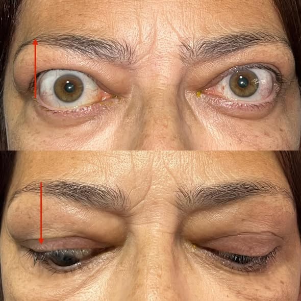 La retracció palpebral (Dalrymple 1849) és el signe més freqüent de l'orbitopatia tiroidea. És una asinergia (falta d'acompanyament) de la parpella superior en la mirada cap avall