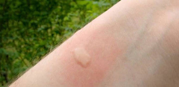 Fava secundària a una picada de mosquit