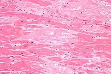 Dipòsit d'amiloide al miocardi (color rosa pàl·lid)